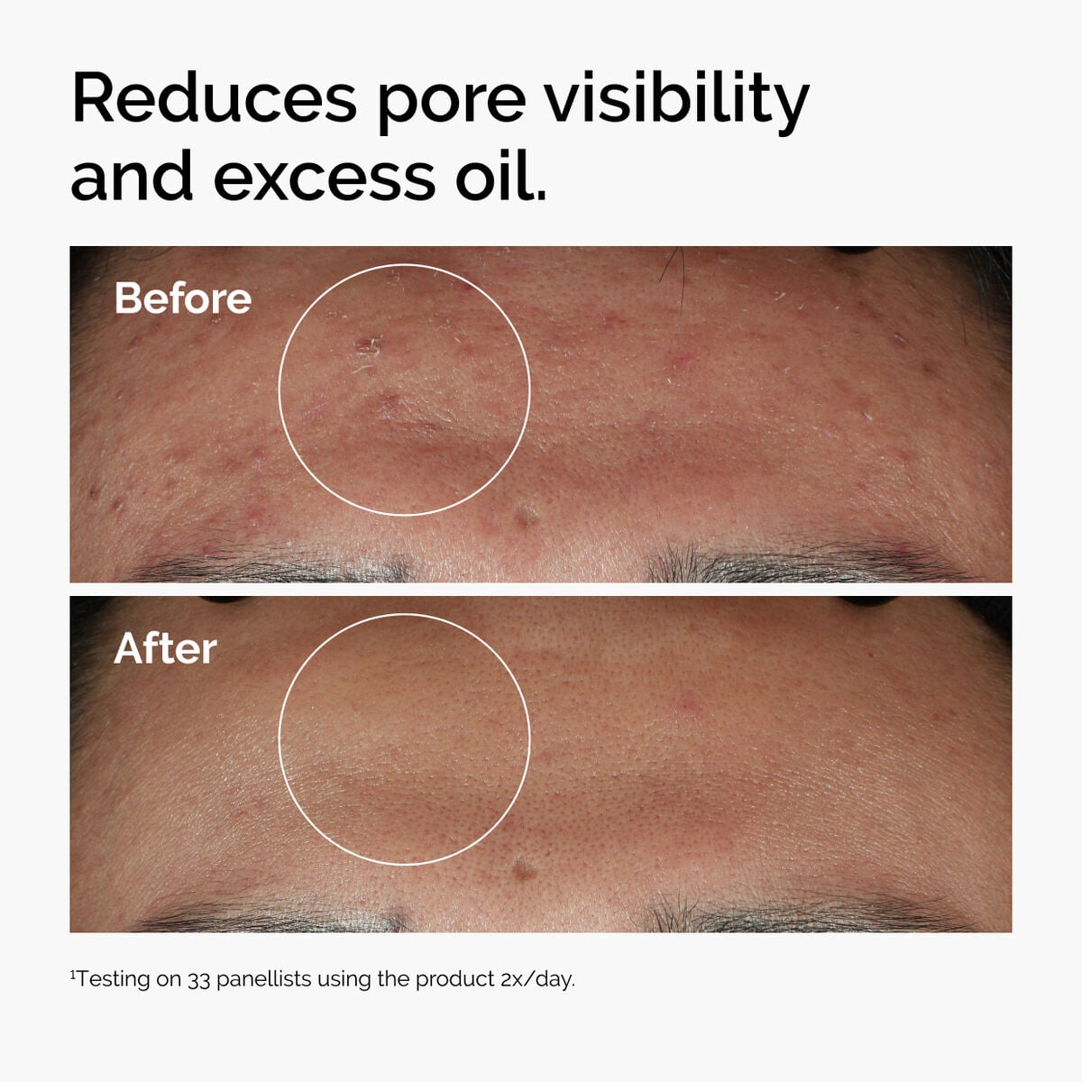 niacinamide-10-zinc-1-q1 ord-niacinamide-zinc-blemish-serum-before-after-pores.jpg