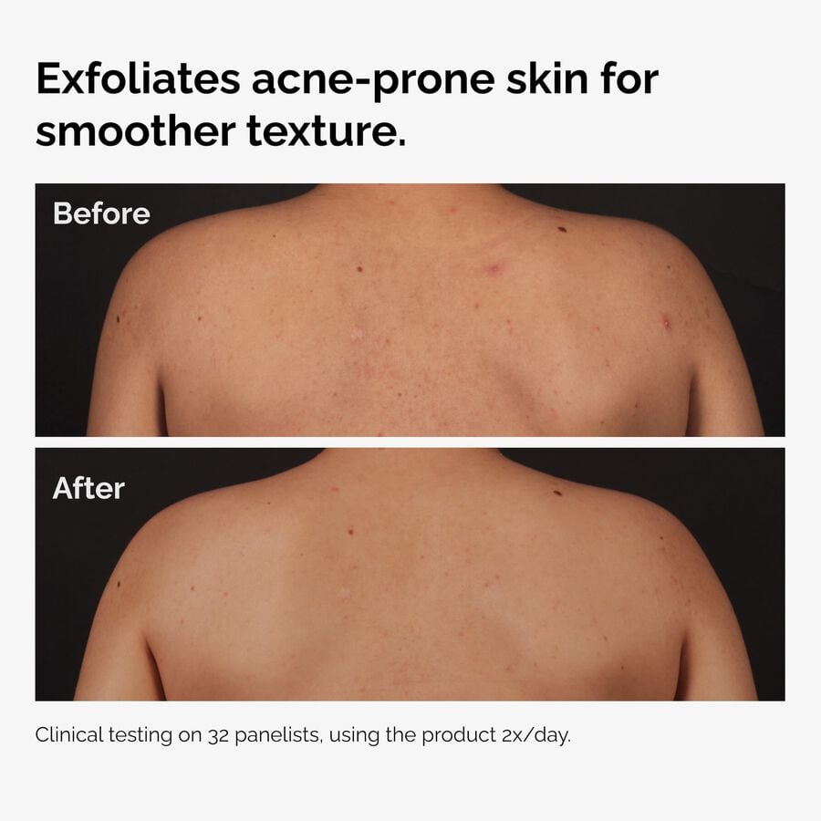 the-body-care-collection-d4 ord-salicylic-acid-body-serum-before-after-graphic-NA.jpg