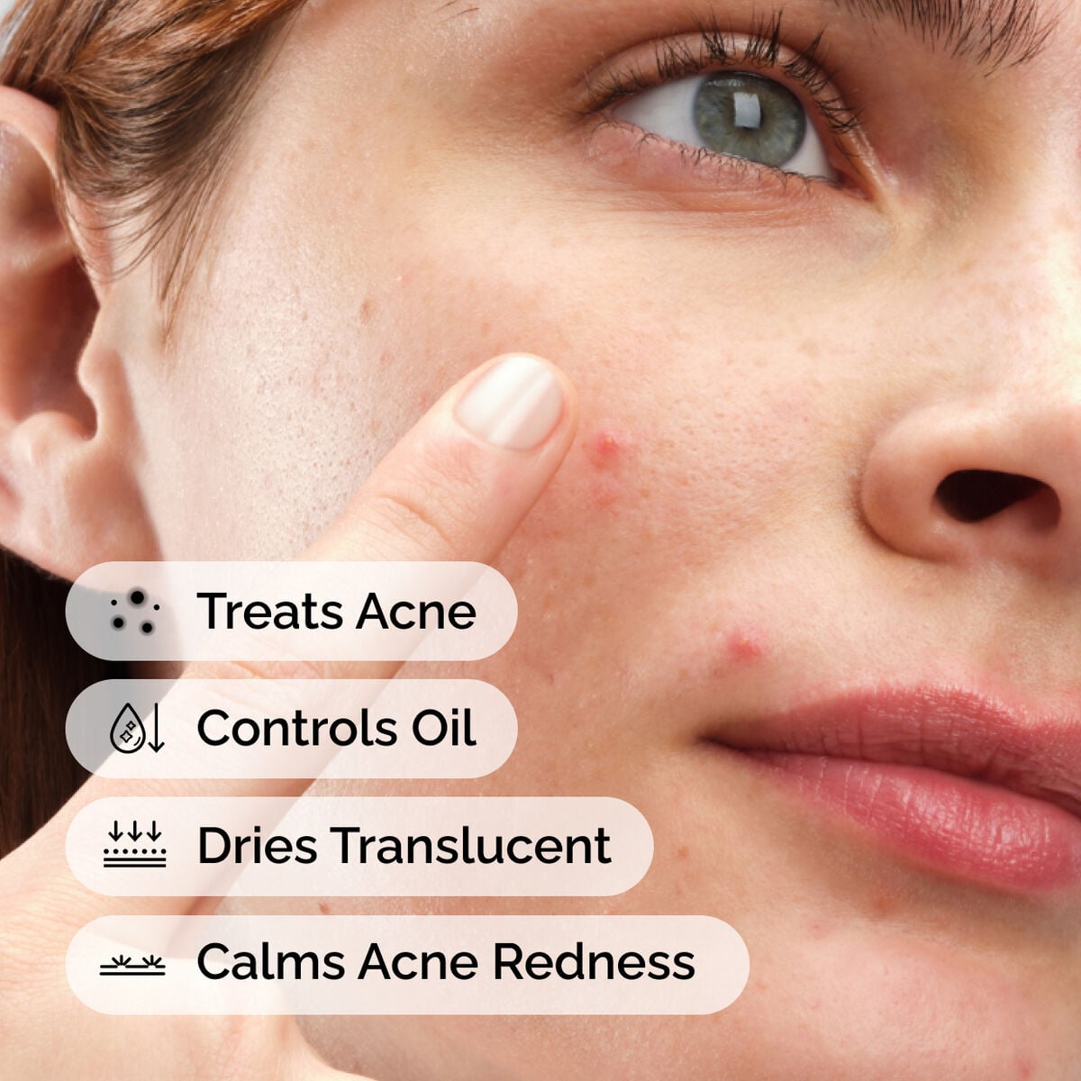 sulfur-10-powder-to-cream-concentrate-y2 ord-sulfur-10pct-powder-to-cream-concentrate-model-application-with-benefits-acne.jpg