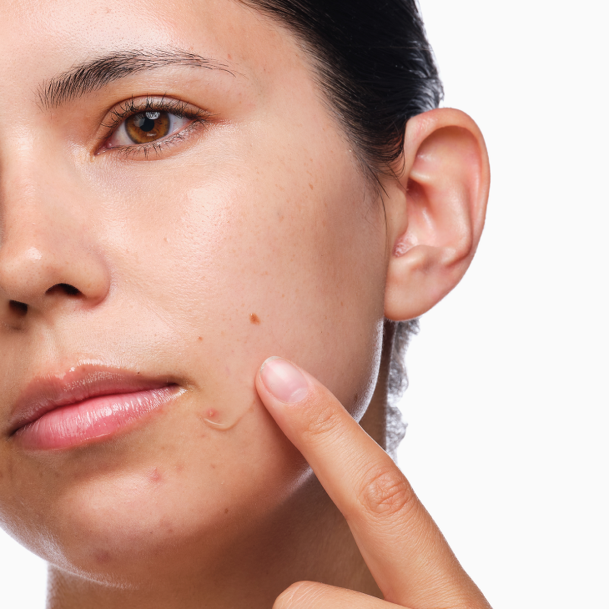 the-acne-set-d6 rdn-the-acne-set-application.png